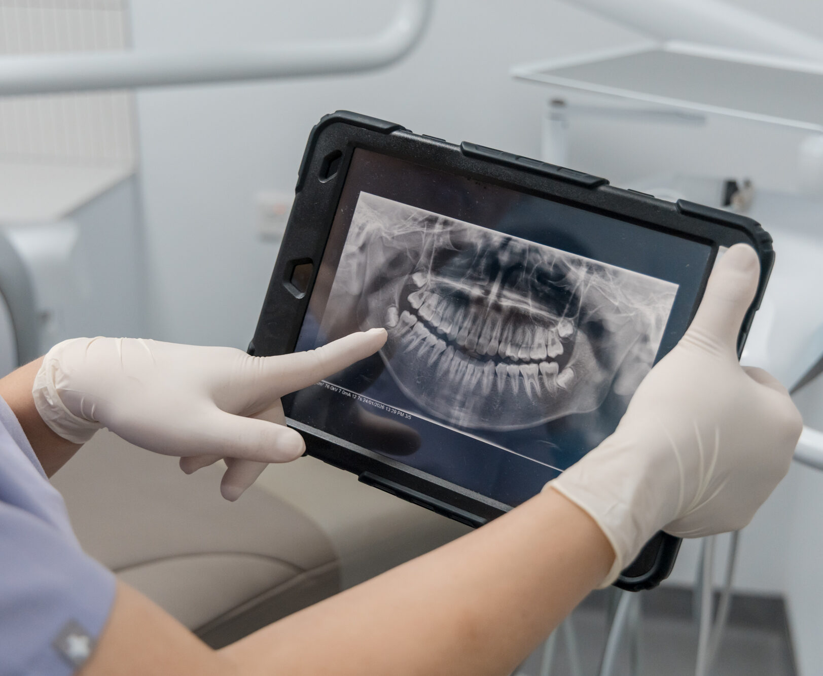 Evaluating a patient's panoramic X-ray on a tablet to check bone structure before dental implants.